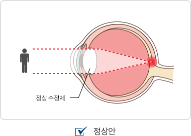 정상안