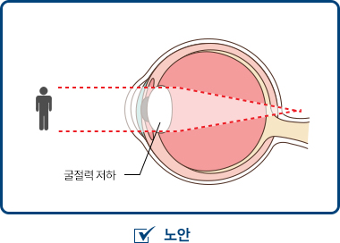 노안