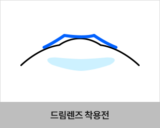 드림렌즈 착용전